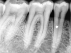 Рентгенографический снимок 1-го зуба (до 2 снимков)