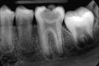 Рентгенографический снимок 1-го зуба (3 и последующий)