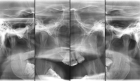 Рентген височно-нижнечелюстного сустава (в 2D) в двух проекциях 