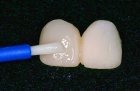Покрытие 1 зуба материалом Biscover LV