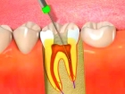 Лечение пульпита и подготовка 2-канального зуба к протезированию
