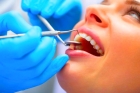 Шинирование дополнительно 1 последующего зуба с использованием «Риббонд», «Гласспан»