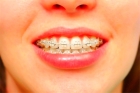 Фиксация брекет-системы (1 зубной ряд без замков)