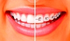 Повторное посещение с установленными брекетами (1 зубной ряд)