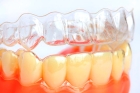 Лечение на прозрачных каппах (элайнерах) «OrthoSnap» (1 зубной ряд)