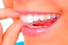 Лечение на двух зубных рядах до 5 капп