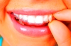 Лечение на двух зубных рядах до 15 капп
