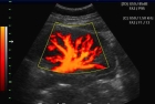 Дупплексное сканирование с ЦДК почечных и внутрипочечных артерий