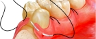 Наложение 3 швов после удаления зуба
