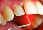 Лечение парадонта зуба с помощью промывание кармана противовоспалительными и ранозаживляющими препаратами