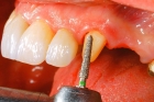 Препарирование одного зуба под штампованную коронку