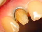 Препарирование одного зуба под коронку из металлокерамики