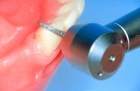 Препарирование одного зуба под коронку из безметаловой керамики Imax