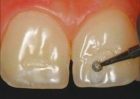 Сошлифовывание твердых тканей зуба 