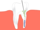 Ультразвуковая обработка корневого канала зуба