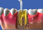 Трехмерное пломбирование корневого канала зуба (Gutta core)