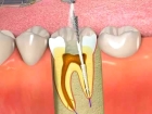 Ультразвуковое расширение корневого канала зуба (стекловолоконный штифт)