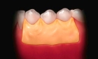 Наложение лечебно-защитной повязки  (1 группа зубов)