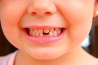 Удаление зуба (временного)