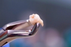 Удаление зуба (сложное)