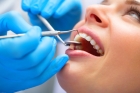 Лечение периодонтита 4-канального зуба