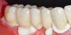 Фиксация металлической коронки на стоматологический цемент