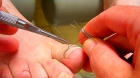  Безоперационная коррекция ногтя скобой фрезера