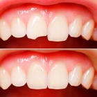 Эстетическая реставрация центральных зубов
