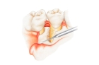 Гингиватомия 2 зуба