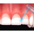 Гингивоэктомия 2 зуба