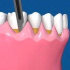 Гингивопластика при ретракции десны в области 1 зуба