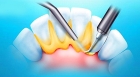 Снятие зубных отложений (зубного камня)
