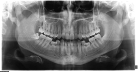 Ортопантомография (ОПГ) панорамный снимок верхней и нижней челюсти