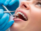Лечение пульпита 2 канального зуба 