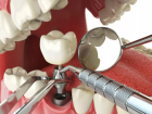 Имплантация после удаления зуба