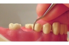 Закрытый кюретаж пародонтальных карманов (1 зуб)