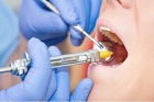 Лечение пульпита постоянных зубов