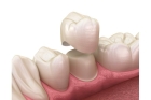 Восстановление коронки зуба под ортопедическую коронку материалами световой полимеризации (пластика под мост)