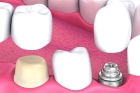 Восстановление коронковой части зубов материалами световой полимеризации после эндодонтического лечения