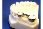 Аппарат для сохранения места постоянного зуба