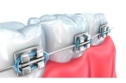 Снятие ортодонтического аппарата и брекет-системы (одна челюсть)