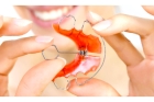 Ортодонтическая коррекция съемным ортодонтическим аппаратом (пластинка)