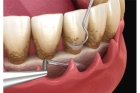 Кюретаж (открытый) пародонтального кармана в области одного зуба
