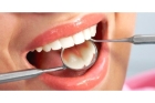 Протезирование нижних зубов на имплантах