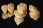 Восстановление зуба коронкой из диоксида циркония