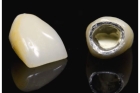Восстановление зуба коронкой металлопластмассовой