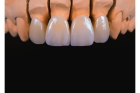 Восстановление зуба коронкой керамической прессованной
