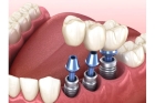 Рассрочка на имплантацию зубов