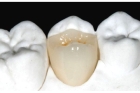 Восстановление зуба вкладками на рефракторе 