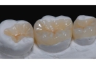 Восстановление зуба с использованием культевой вкладки на основе диоксида циркония
